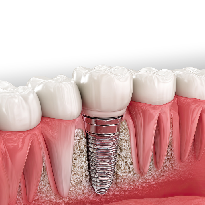 Dental Implants